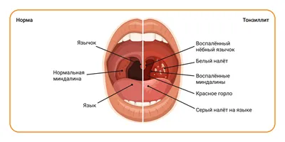 Тонзиллит | Симптомы | Диагностика | Лечение - Lik.ua