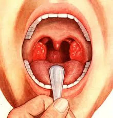 Промывание миндалин: эффективный способ избавления от проблем дыхательных  путей. | Первый Медцентр | Дзен