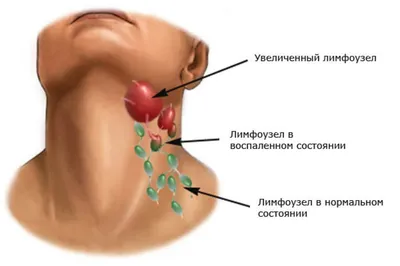 НЕМНОГО ПРО ЛИМФОУЗЛЫ! - Oncohelp