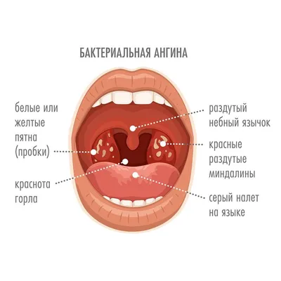 Острый тонзиллит — Википедия