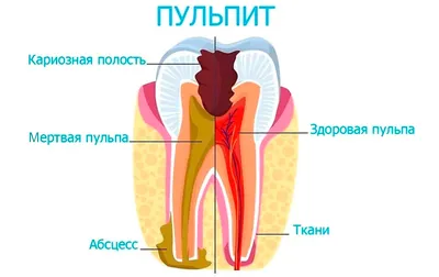 Тонзиллит у детей - причины, симптомы, лечение в клинике «Будь Здоров»