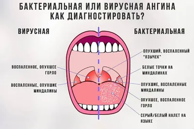 Нужео ли удалять гланды: как, зачем и в каких случая это необходимо —  Актуальная тема