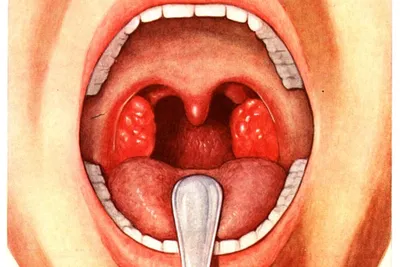 Тонзиллит: симптомы и лечение болезни, признаки и причины хронического  тонзиллита