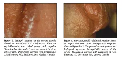 Вирус папилломы человека. Последствия для мужчин НАГЛЯДНО — CMT Научный  подход