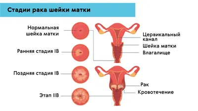 Вирус папиломы человека: симптомы, типы вируса и лечение в Красноярске