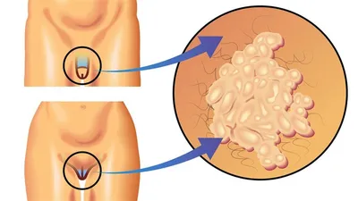 Лечение вируса папилломы человека (ВПЧ) у женщин и мужчин