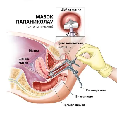 Вопросы и ответы о вирусе папилломы человека (ВПЧ) | Госпиталь Сант Жоан де  Деу Барселона