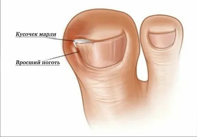 Вросший ноготь (онихокриптоз) - все о заболевании простыми словами