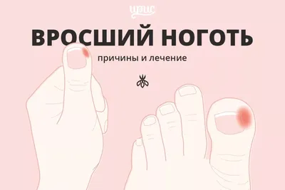 Вросший ноготь – признаки, причины, симптомы, лечение и профилактика вросшего  ногтя у взрослых | «Будь Здоров»