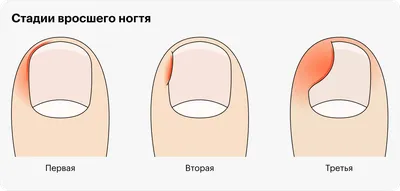 Вросший ноготь (онихокриптоз) - все о заболевании простыми словами