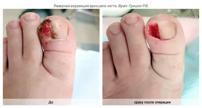 ⭐ Как лечить вросший ноготь? - Безболезненное удаление - podonails.com