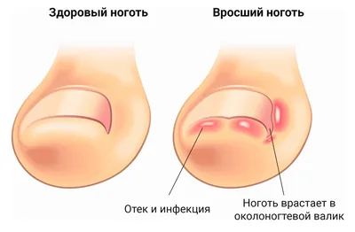 Вросший ноготь на большом пальце ноги лечение в Минске