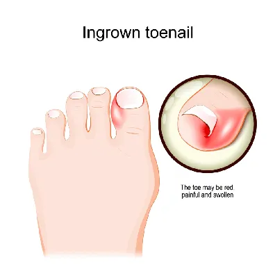 Вросший ноготь (онихокриптоз) - все о заболевании простыми словами