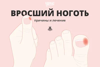 Вросший ноготь. Что делать | SBS-MED