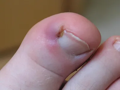 Ingrown nail on a small toe 🦶 What to do? - YouTube