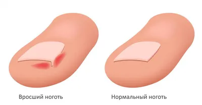 Статьи :: Вросший ноготь - что делать?