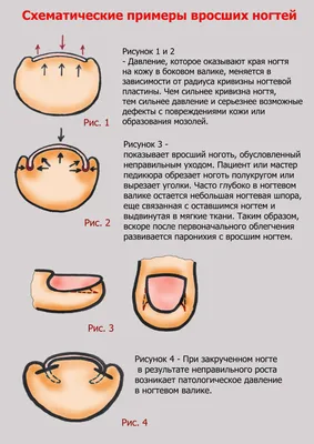 Вросший ноготь: лечение и удаление быстро и безболезненно в Москве