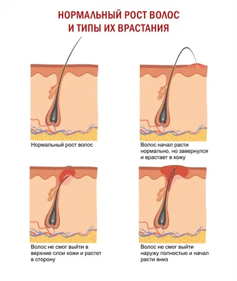 Как бороться с вросшими волосами