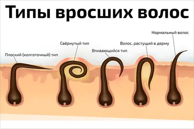 Плакат обучающий А1 ламинир. типы вросших волос косметологический по  эпиляции депиляции 610x914 мм - купить с доставкой по выгодным ценам в  интернет-магазине OZON (352462200)