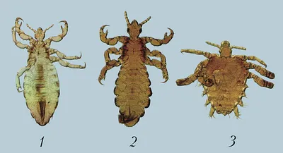 ᐉ Вши: фото как выглядят укусы вшей на теле, голове и волосах человека