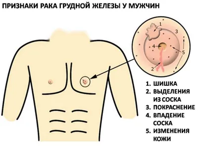 Что нужно знать о раке молочной железы, чтобы не пропустить болезнь |  KP.RU:Комсомольская правда | Дзен