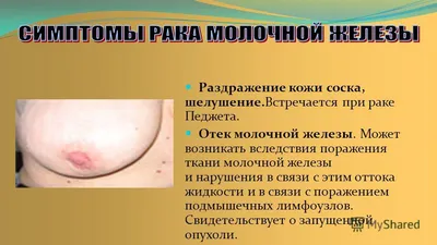 Внешние признаки рака молочной железы - Квитна