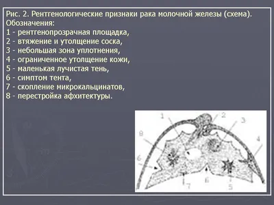 Втянутый сосок - особенность строения или признак рака груди? |  dr.dzhunkovskaya | Дзен