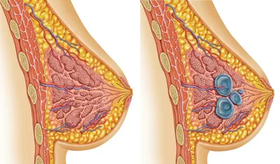 Рак молочной железы