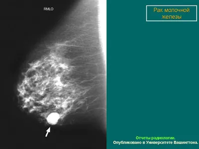 Молочная железа. Маммография в комплексной диагностике рака молочной  железы. + | Портал радиологов
