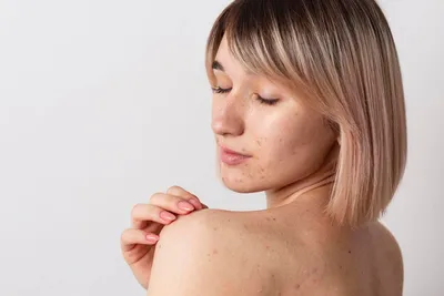 Лечения вульгарных угрей (Acne vulgaris) у взрослых и подростков, какие  методы физиотерапии применяются? | Блог - Международная Клиника Ибни Сино