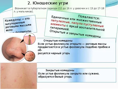 Image: Пиодермия на лице (связанная с беременностью) - Справочник MSD  Профессиональная версия