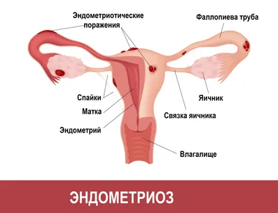 Вульводиния – какие симптомы не должны упустить женщины? - HTI CENTERS |  Medical Tourism Center