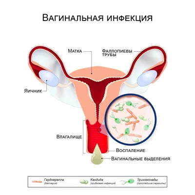 Начнём разбор темы вульвовагинитов у... - Vopros_k_ginekologu | Facebook