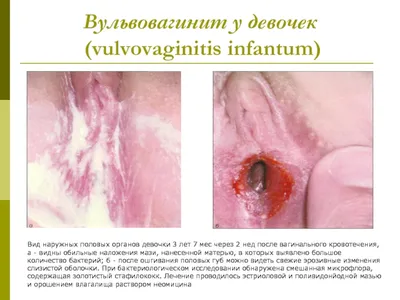 Общие сведения о вагините (инфекция или воспаление влагалища) - Проблемы со  здоровьем у женщин - Справочник MSD Версия для потребителей