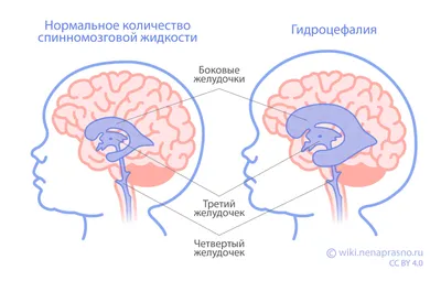 Неврологический Центр \"Кортекс\" - ДИАГНОСТИКА ВНУТРИЧЕРЕПНОЙ ГИПЕРТЕНЗИИИ  (ВЧГ)!🐒 ВЧГ состоит из нескольких компонентов: давление внутримозговой  жидкости♨️ (ликвор), эластичность мозговой ткани, осмотического давления  внутриклеточной и внеклеточной ...