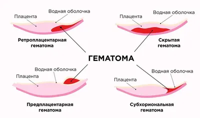 Можно ли делать медикаментозный аборт после аборта или кесарева сечения,  когда и до скольких недель; бесплодие после аборта.