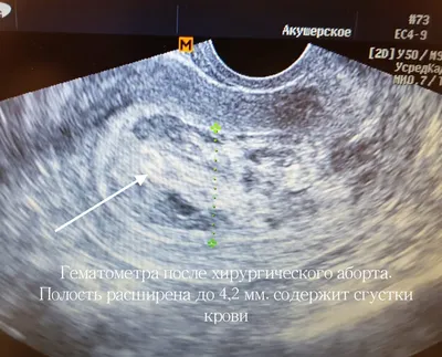 Виды и последствия аборта: взгляд врача - Блог НаПоправку