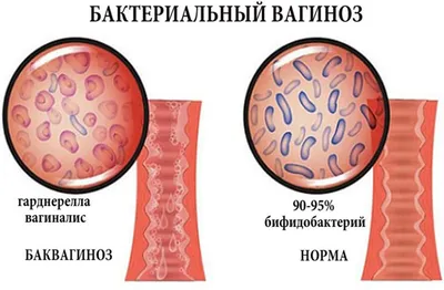 Выделения при баквагинозе фото