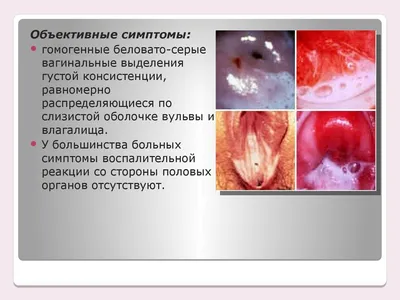 Гарднереллез: свечи при лечении у женщин и симптомы гарднереллы