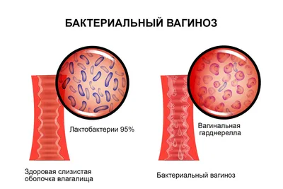 Бактериальный вагиноз: симптомы, причины, признаки, осложнения, что делать  при дисбактериозе влагалища