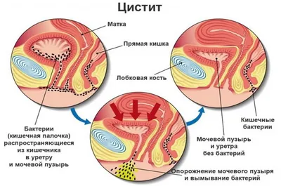 Выделения при климаксе: запах, цвет, причины.