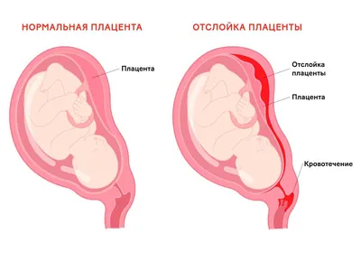 Отслойка плаценты на ранних сроках беременности: причины, симптомы, лечение