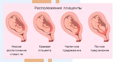 Гематома на ранних сроках беременности - Иркутский городской перинатальный  центр имени Малиновского М.С.