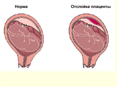 Почему происходит преждевременная отслойка нормально расположенной плаценты?  | Клуб лучших мам! | Дзен