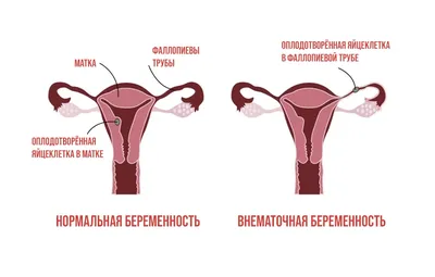 ОТСЛОЙКА плодных оболочек, ПЛАЦЕНТАРНАЯ НЕДОСТАТОЧНОСТЬ и антенатальная  ГИБЕЛЬ ПЛОДА на 30 неделе. - YouTube