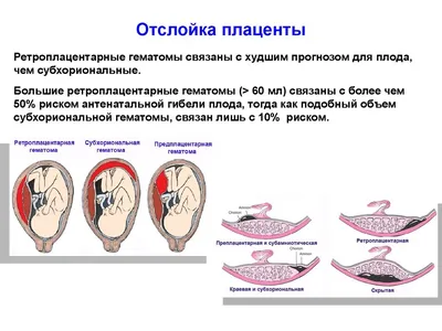 Преждевременная отслойка нормально расположенной плаценты - презентация  онлайн