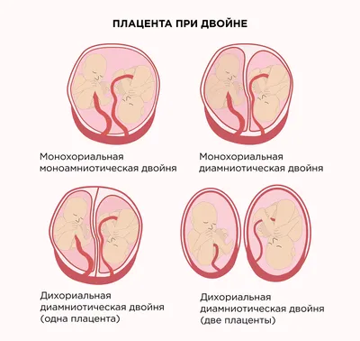 Как я родила с отслойкой плаценты