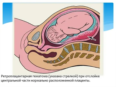 Предлежание плаценты: причины, симптомы и лечение в статье врача УЗИ  Белкина Л. В.