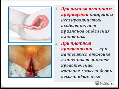 Презентация на тему: \"Кровотечения в родах и раннем послеродовом периоде.  Лекция 7 ПМ 02 «Участие в лечебно-диагностическом и реабилитационном  процессах»\". Скачать бесплатно и без регистрации.