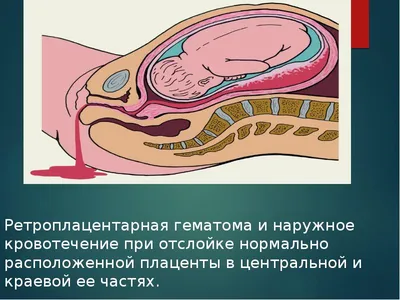 Презентация на тему: Отслойка плаценты;Травма родовых путей